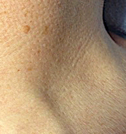 Skin Tags After